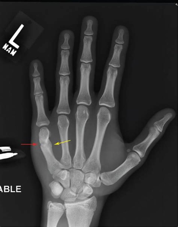 How is a boxers fracture treated