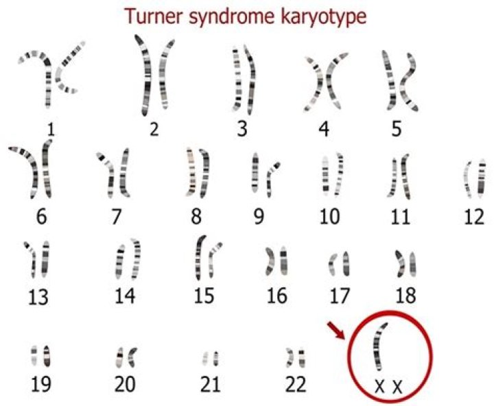 Is Turner syndrome male or female