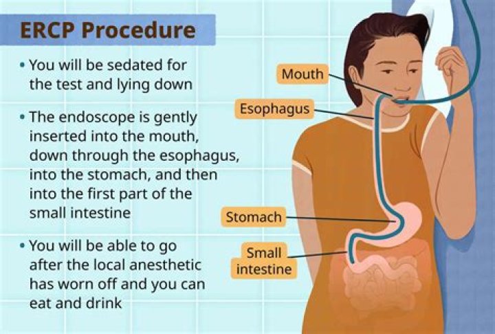 What can you not do after an ERCP