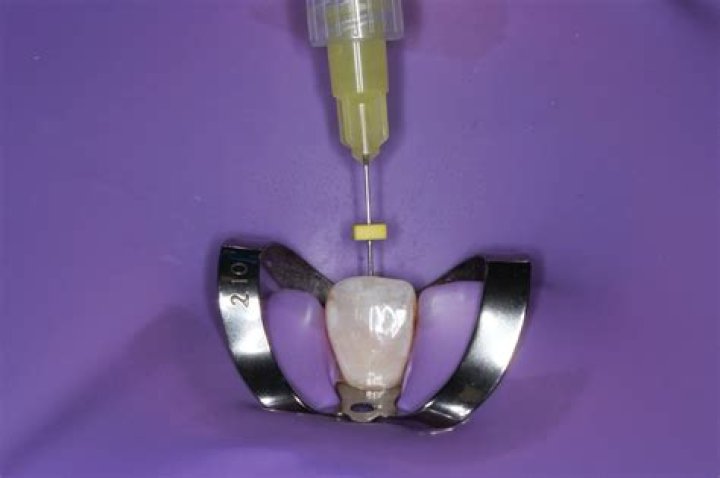 What does a pulp extirpation mean