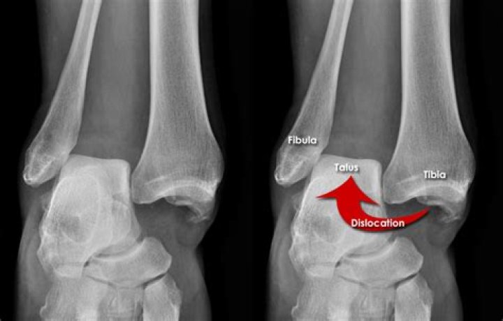 What is a subtalar dislocation
