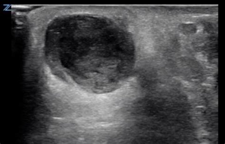 What is an abscess in the neck