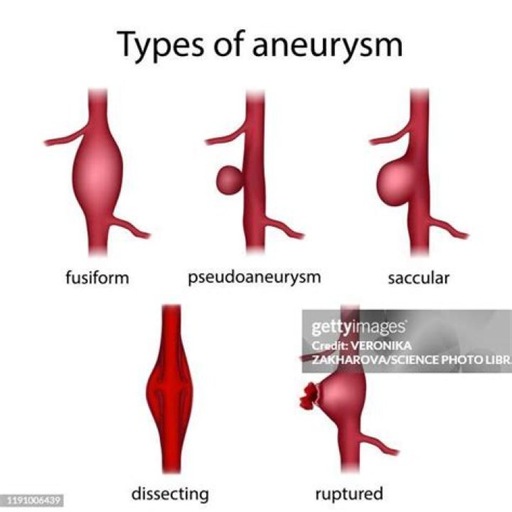 What is an aneurysm in the ear