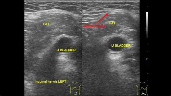 What is an inguinal ultrasound
