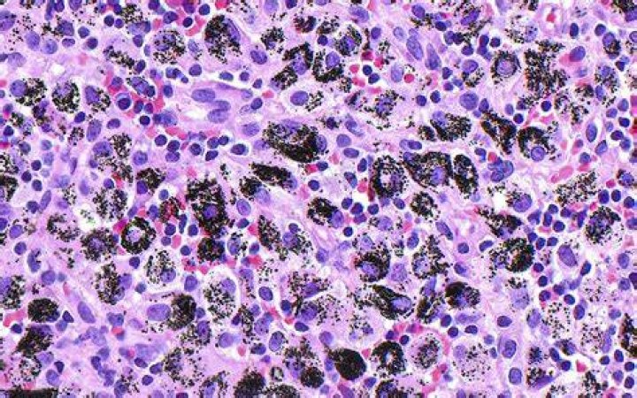 What is Anthracotic lymph node