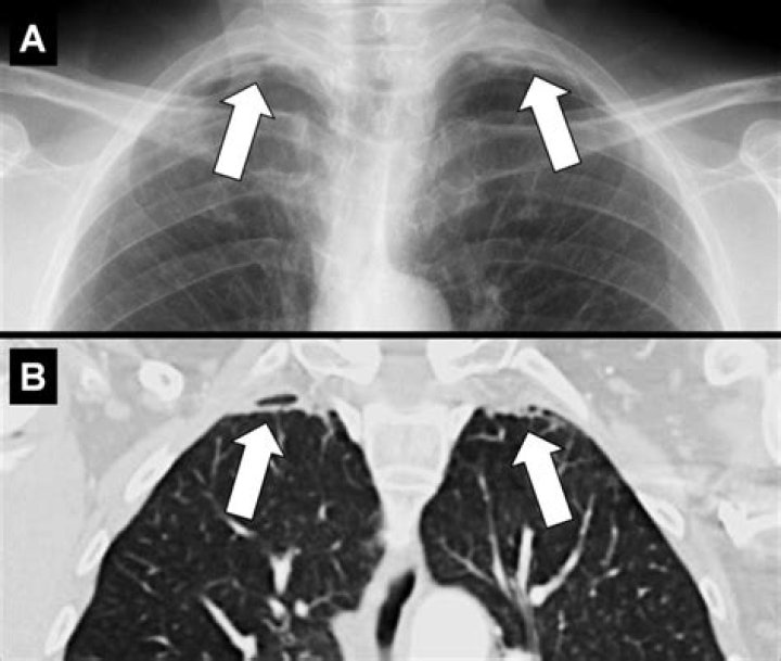 What is apical pleural capping