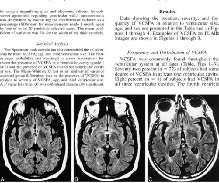 What is CSF pulsation artifact
