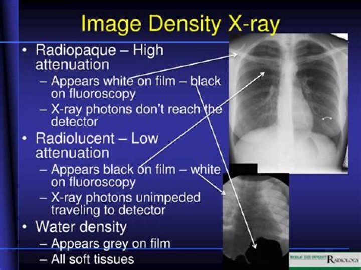What is density in radiography