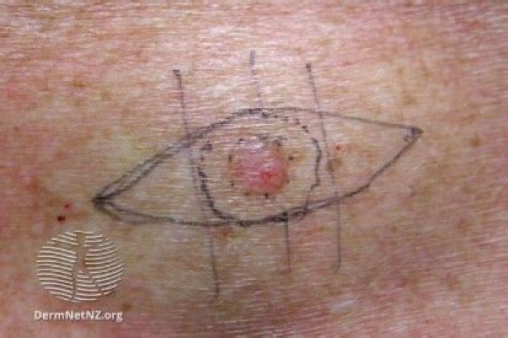 What is Excision benign lesion