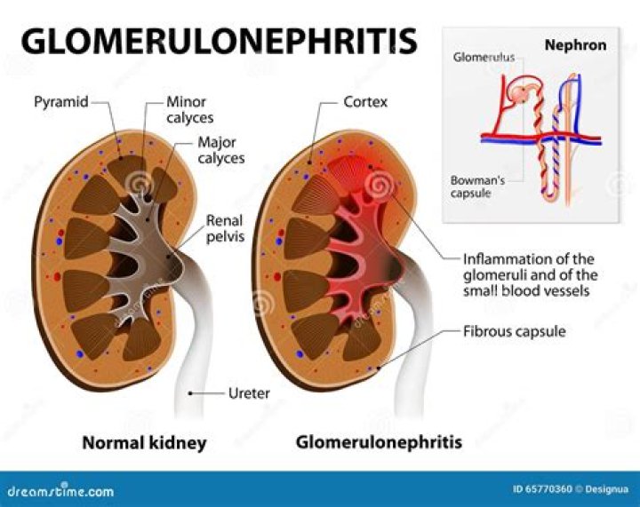 What is glomerular nephropathy