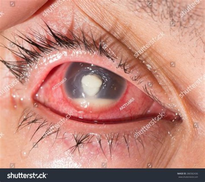 What is Hypopyon corneal ulcer