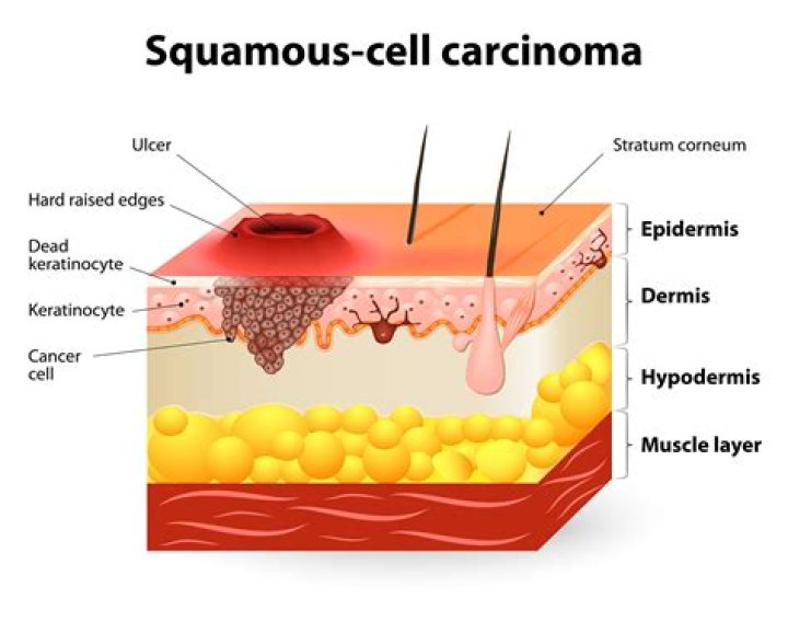What is keratinocyte carcinoma