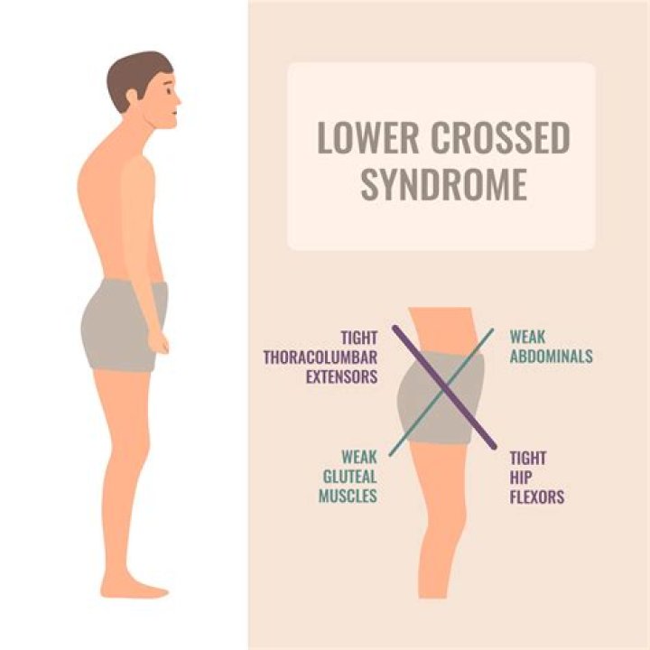 What is lower crossed syndrome