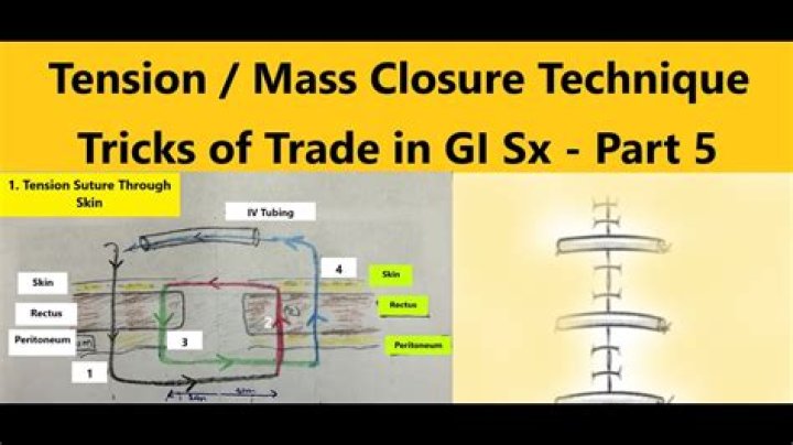What is mass closure technique