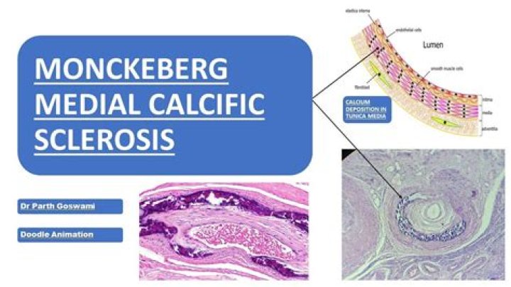 What is Monckebergs sclerosis