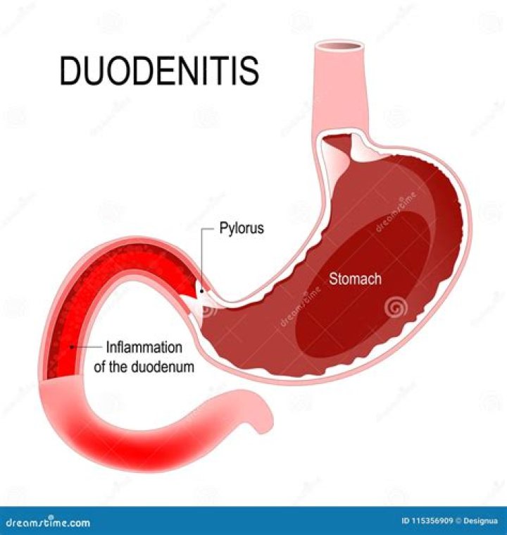 What is non erosive duodenitis