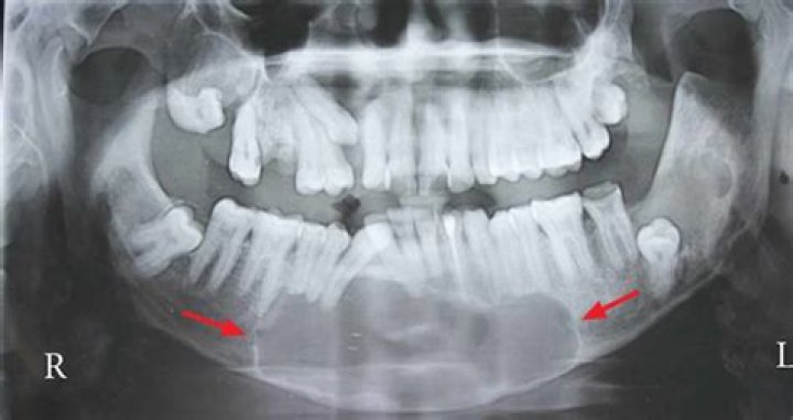 What is odontogenic Keratocyst