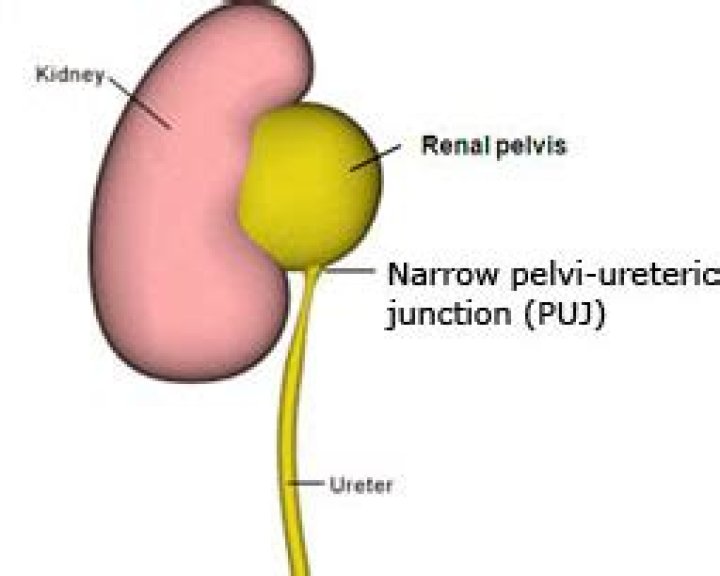 What is PUJ obstruction kidney